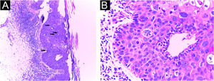 Histopathology of an incisional biopsy, which suggested the diagnosis of pigmented SCC in situ. (A) Compact hyperkeratosis, acanthosis and pigment deposits, in addition to atypical keratinocytes and mitoses in the middle portion of the epidermis (Hematoxylin & eosin, ×40). (B) At higher magnification, atypical keratinocytes and mitoses (Hematoxylin & eosin, ×400).