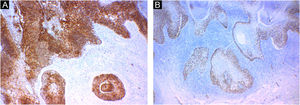 Immunohistochemistry. (A) Positivity for EMA (epithelial membrane antigen). (B) Positivity for p63 protein.