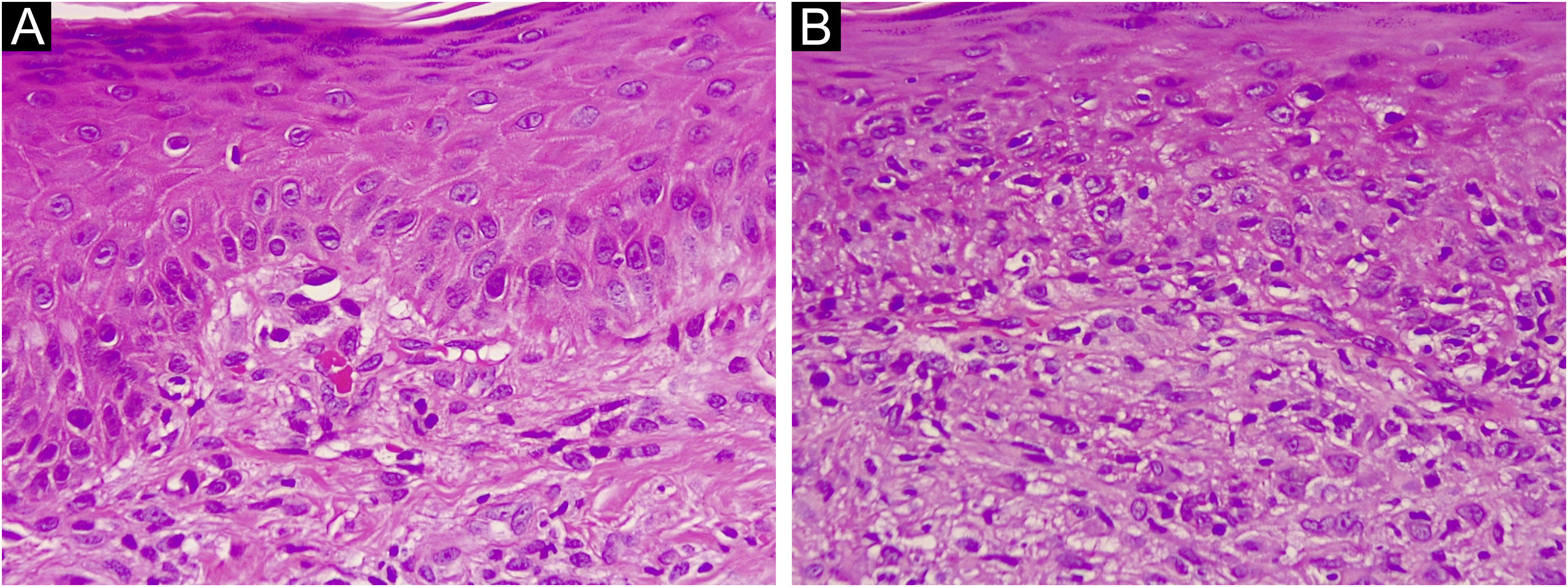 Dermoscopy of pityriasis lichenoides et varioliformis acuta (PLEVA ...
