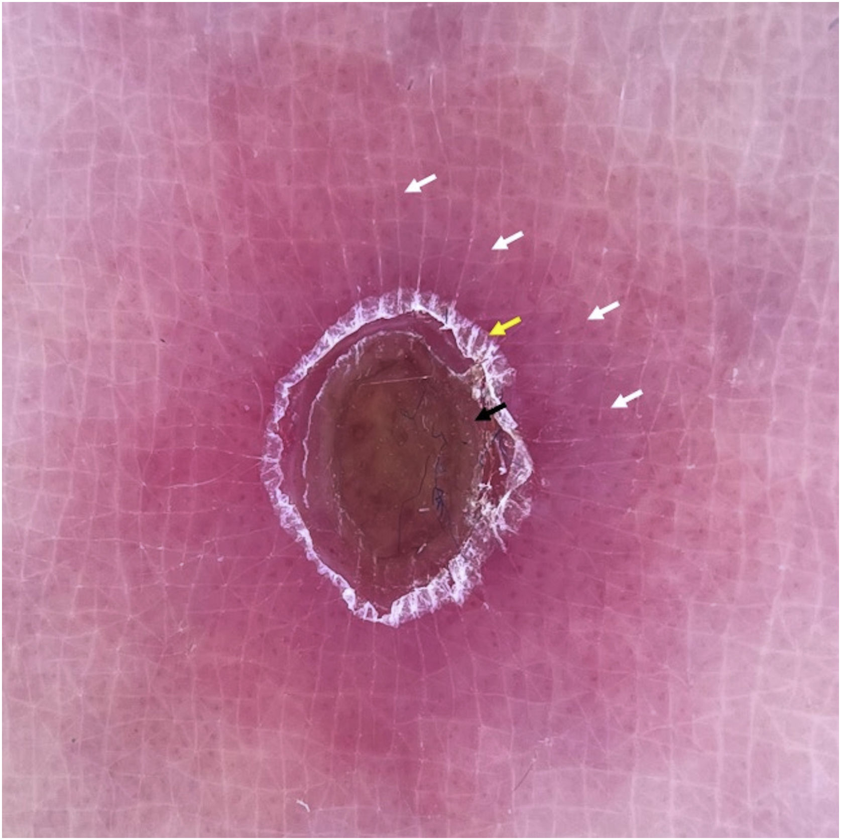 Dermoscopy of pityriasis lichenoides et varioliformis acuta (PLEVA ...