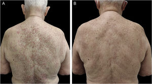 (A) Multiple erythematous annular plaques on the back and posterior neck at the initial visit. (B) Complete resolution of the lesions after 5 months under treatment with doxycycline 100 mg/day