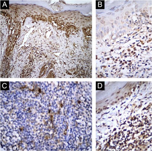 Immunohistochemical findings: (A‒B) IL-1β. (C‒D) IL-17. A‒C, SLE patients; B‒D, patients with purely cutaneous lupus erythematosus lesions (Original magnification: A = ×100; B‒D = ×400).