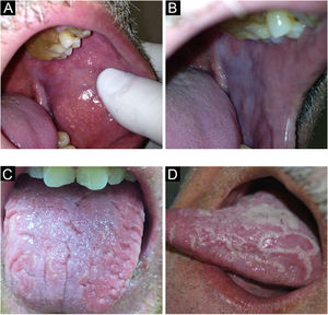 (A) Fordyce granules. (B) Leukoedema. (C) Fissured tongue. (D) Geographic tongue