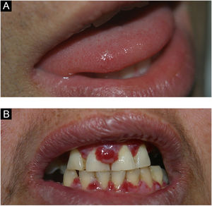 (A) Transient lingual papillitis. (B) Gingival hyperplasia