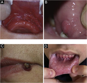 (A) Fissured epulis. (B) Traumatic fibroma. (C) Pyogenic granuloma. (D) Morsicatio buccarum