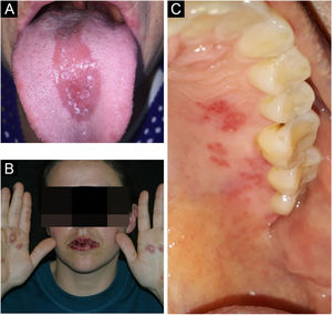 (A) Candidiasis. (B) Labial herpes simplex associated with target lesions on hands. (C) Herpes zoster with unilateral erosions (kindly provided by Prof. Hiram Larangeira de Almeida Jr.)