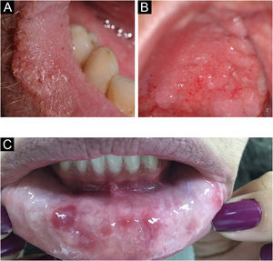 (A) Labial moriform lesion (kindly provided by Prof. Sílvio Alencar Marques). (B) Moriform stomatitis (kindly provided by Prof. Sílvio Alencar Marques). (C) Syphilis