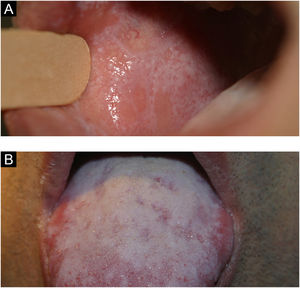 (A) Lichen planus (oral mucosa). (B) Lichen planus (tongue)