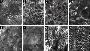 RCM images illustrating some key consensus terms. (A) Polymorphic pagetoid cells – round (red arrow) and dendritic (yellow arrows). (B) Ringed pattern – edged papillae (asterisks). (C) Meshwork pattern – non-edged papillae (asterisks) and dendritic cells in the interpapillary spaces (red arrows). (D) Dense nests (asterisks). (E) Tumor islands (asterisks), peritumoral dark cleft (yellow arrow) and dilated linear blood vessels (red arrow). (F) Tumor island (asterisk), peripheral palisading (red arrow) and peritumoral dark cleft (yellow arrow). (G) Polycyclic and polymorphic papillae (asterisks). (H) Cords and bulbous projections (yellow arrows)