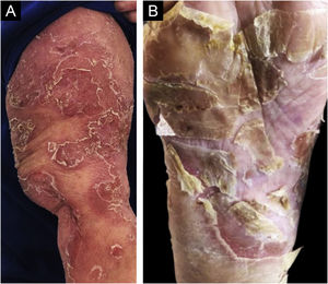 (A) Erythematous-desquamative lesions on the arm, with circinate edges and lamellar desquamation. (B) Plantar lamellar desquamation