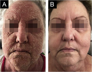 (A) Desquamation of the entire face before treatment. (B) Complete resolution with therapy