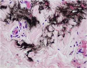 Drug delivery with MMP® technique. This is a cross section of the reticular dermis demonstrating ink between the collagen fibers, without bolus formation