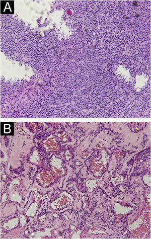 Light Microscopy of glomus tumor. (A) Solid glomus tumor was composed of monotonous round cells in solid sheets. (B) Glomangioma showed a large number of vascular lumens, which were surrounded by several layers of glomus cells. (Hematoxylin & eosin, ×100).