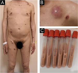 (A,B) Dermatological examination revealed erythematous and brownish papules, nodules and abscesses scattered throughout the body with varying sizes. Some lesions exhibited umbilicated central necrotic ulcerations and the abscesses were fluctuant and expressed yellow white purulent discharge. (C) The contents of the test tube are drawn from the abscess.