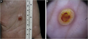 Solitary adult xanthogranuloma of the palm. (A) Yellowish 5 mm dome-shaped papule with central erythematous crust and a desquamative erythematous peripheral rim. (B) Dermoscopy showing homogeneous symmetric yellow structure-less areas with a central crust and pink surrounding rim (‘setting sun’ pattern).