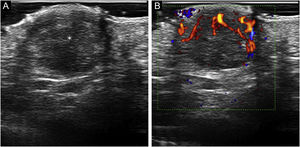 Sonographic characteristics of volar adult xanthogranuloma. (A) Grayscale sonogram (transverse view, right palm) showing a well-defined hypoechoic, dermal, and hypodermal nodule (asterisk) displacing the epidermal layer upwards; (B) Color Doppler sonogram of the same lesion showing inner vascularity.