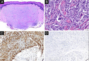 Histological characteristics of volar adult xanthogranuloma. (A and B) Dermal proliferation of mononucleated foamy histiocytes and Touton’s giant cells (Hematoxylin & eosin, ×40 and ×400, respectively). (C and D) Immunohistochemical stains revealing CD68 positive and CD1a negative foamy histiocytes, respectively (magnification ×200).