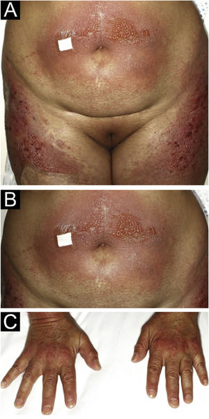 (A) Intense erythematous rash on the abdomen and thigs associated to the presence of vesicles and bullas. (B) Magnification of vesicles and bullas on the abdomen. (C) Gottron’s sign.