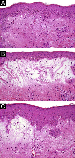 (A) 10× Hematoxylin-eosin staining; hydropic changes in the basal layer. (B and C) 10× Hematoxylin-eosin staining with marked dermal edema and bullae formation with mild lymphocytic infiltrate around superficial vessels.
