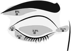 Periocular tumors location. (A) Medial canthus. (B) Upper eyelid. (C) Lower eyelid. (D) Lateral canthus. (E) Eyebrow.