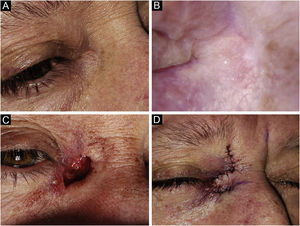 Basal Cell Carcinoma (BCC), micronodular subtype. Reconstruction with a transposition flap. (A) Tumor was located on the medial canthus on an adult female. (B) Dermoscopy showed in-focus arborizing short-fine telangiectasia and multiple aggregated yellow-white globules, characteristic of BCC. (C) Mohs micrographic surgery was performed achieving tumor-free margins in 2 stages, creating a deep canthal defect. (D) A rhomboidal flap was used to close the defect, without tension.