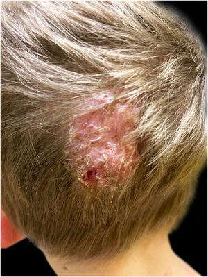 Erythematous purulent and crusted Kerion Celsi of the scalp, with loose hair falling out at the periphery of the lesion.