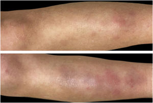 Bilateral erythematous tender nodules of the lower extremities clinically suggestive of erythema nodosum.