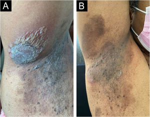 Right axilla before (A) and after (B) eight weeks of treatment. Considerable reduction in ulcerous-crusted plaques and blisters, with a predominance of residual hyperchromia at the end of treatment.
