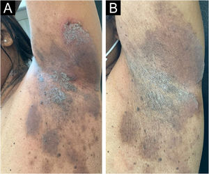 Left axilla before (A) and after (B) eight weeks of treatment. Decrease in ulcerous-crusted plaques and blisters, and predominance of residual hyperchromia at the end of treatment.