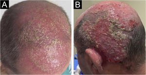 (A) Clinical aspect with follicular pustules. (B) Slightly vegetative area with pustules and crusts.