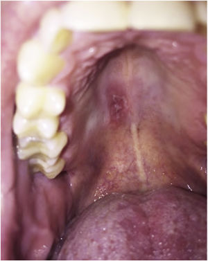 Oral candidiasis with the use of anti-IL17.