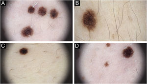 Dermatoscopic images of different lesions showing typical reticular distribution (A‒D).