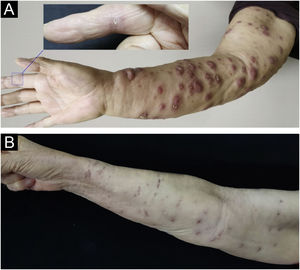 (A) The finger was injured while handling the fish and diffuse nodules of the right upper extremity (At the time of the visit). (B) After six months of combined oral rifampin and clarithromycin treatment, the nodules all subsided, leaving scars.