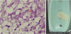 (A) The Ziehl-Neelsen stain showed an acid-fast bacillus, red arrow indicates acid-fast bacillus. (B) Smooth, yellow colonies visible on Löwenstein-Jensen medium after 14 days culture.