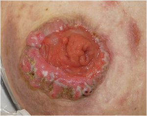 Hyperkeratotic lesions presenting with well-circumscribed vegetating and keratotic appearances surrounding the stoma.