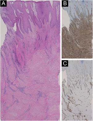 (A) Histopathological features showing fibrosis of the thickened dermis. (B) Immunohistochemical examination using anti-vimentin antibody showed proliferation of mesenchymal cells. (C) The vessels in the dermis were increased in number, which were positive for CD31.