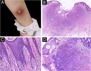 (A) A pinkish nodule with an ulcerated surface on the inner of the left leg. (B) Ulcerated lesion, and infiltrative growth (Hematoxylin & eosina, ×10). (C) Melanocyte proliferation with angulated nuclei in a lentiginous pattern (Hematoxylin & eosina, ×200). (D) Pseudoepitheliomatous hyperplasia and epithelioid melanocytes partially in nests in the upper dermal component (Hematoxylin & eosina, ×40).