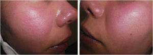 Patient at the time of first consultation with evidence of profuse erythema predominantly on cheeks.