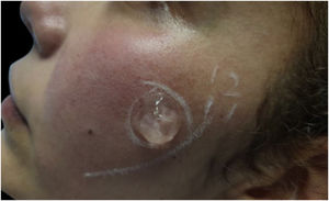 Trial of IPL therapy on a small area of the left cheek, after six months of pharmacotherapy with pregabalin and duloxetine, but persistence of erythema.