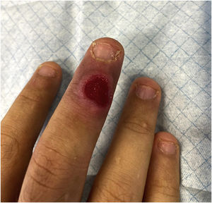 Ulcer on the third finger of the right hand.