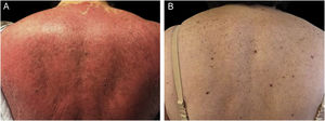 (A) Erythrodermic psoriasis; (B) Remission after guselkumab therapy.