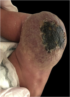 Progressive decrease in the volume of the tumor was seen 6 months of subsequent follow-up in consultation, disappearing ulceration with central necrosis and a persistent redundant skin plaque with residual surface telangiectasia.