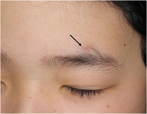 A slightly dome-shaped subcutaneous nodule above the left eyebrow (arrow).