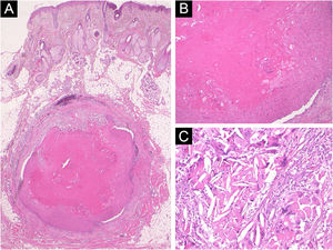 (A) Histopathological examination showing a cystic structure located in the subcutaneous tissue (Hematoxylin & eosin, ×20). (B) Higher magnification shows that the cyst walls keratinize towards the lumen without forming granular cell layers (Hematoxylin & eosin, ×200). (c) Cholesterin crystals and foreign body giant cells (Hematoxylin & eosin, ×200).