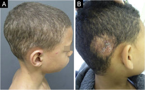 (A) Tinea capitis, Trichophyton tonsurans clinical type. (B) Tinea capitis, Kerion celsi inflammatory clinical type.