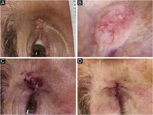 Basal Cell Carcinoma (BCC), nodular subtype. Reconstruction with primary closure. (A) Tumor located on the medial canthus on an adult Male. (B) Dermoscopy showed in-focus arborizing telangiectasia, characteristic of BCC. (C) Mohs micrographic surgery was performed achieving tumor-free margins in 1 stage. (D) Primary closure was used for repair, without tension.