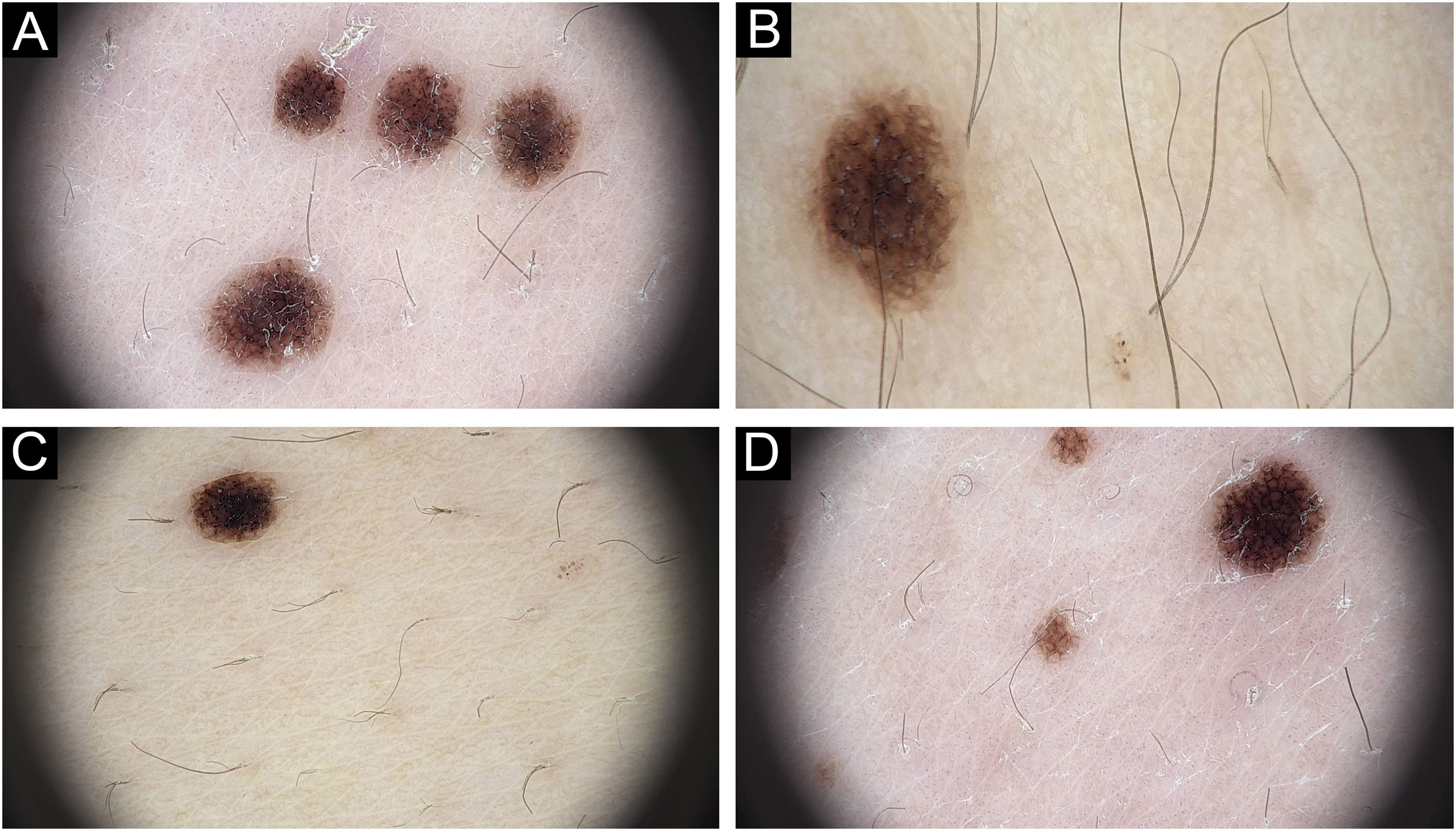 Eruptive disseminated spitz nevus: a case report and review of the ...