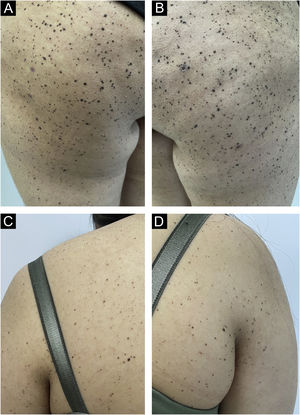 Hundreds of dome-shaped, hyperpigmented nevi on bilateral hips, legs and trunk (A‒C).