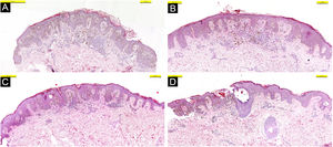 Hematoxylin-eosin stained sections of four different lesions (A‒D); Symmetric junctional Spitz nevus with no mild atypia is seen.
