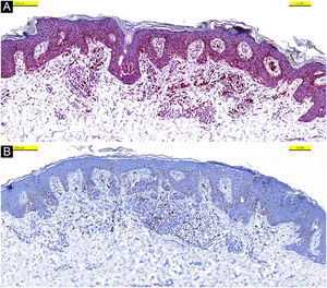 Nuclear expression of BAP-1 in keratinocytes and melanocytes (A), no immunohistochemical staining was observed with PRAME (B).